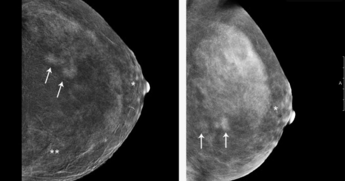calcium deposits on the breast Calcium deposits on the breast